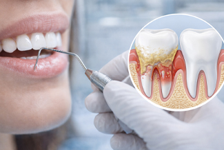 Periodontoloji